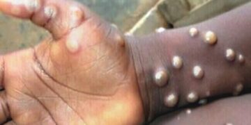 मंकीपक्सको संक्रमण फैलिएपछि अफ्रिकी मुलुकहरूमा स्वास्थ्य आपतकाल घोषणा