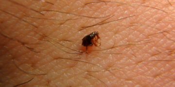 मकवानपुरमा स्क्रब टाइफसका बिरामी ७० पुगे