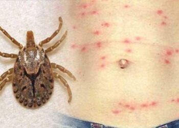 एक हजारभन्दा बढीलाई स्क्रब टाइफस सङ्क्रमण