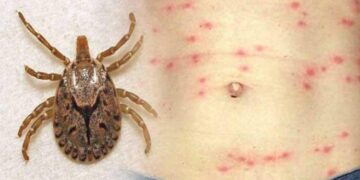 एक हजारभन्दा बढीलाई स्क्रब टाइफस सङ्क्रमण