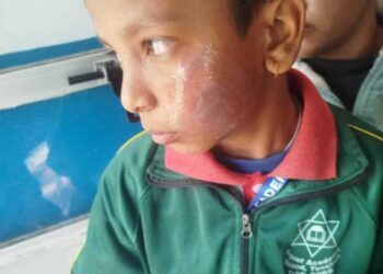 प्रिन्सिपलकै छोरीबाट विद्यार्थीको गालामा तातो पन्युले डामियो