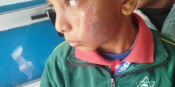 प्रिन्सिपलकै छोरीबाट विद्यार्थीको गालामा तातो पन्युले डामियो